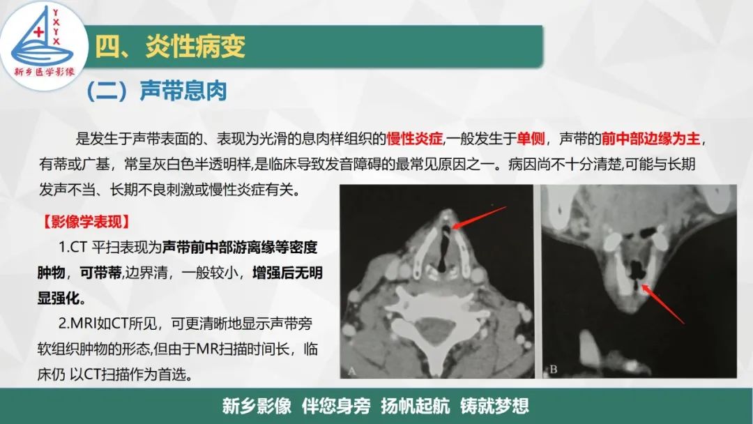 影像PPT - 【PPT】医学影像诊断学教材解读—喉部疾病-21