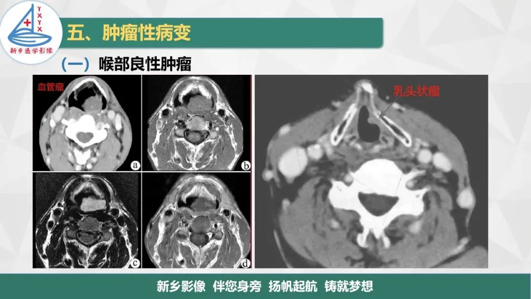 影像PPT - 【PPT】医学影像诊断学教材解读—喉部疾病-24