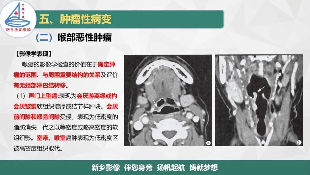 影像PPT - 【PPT】医学影像诊断学教材解读—喉部疾病-26