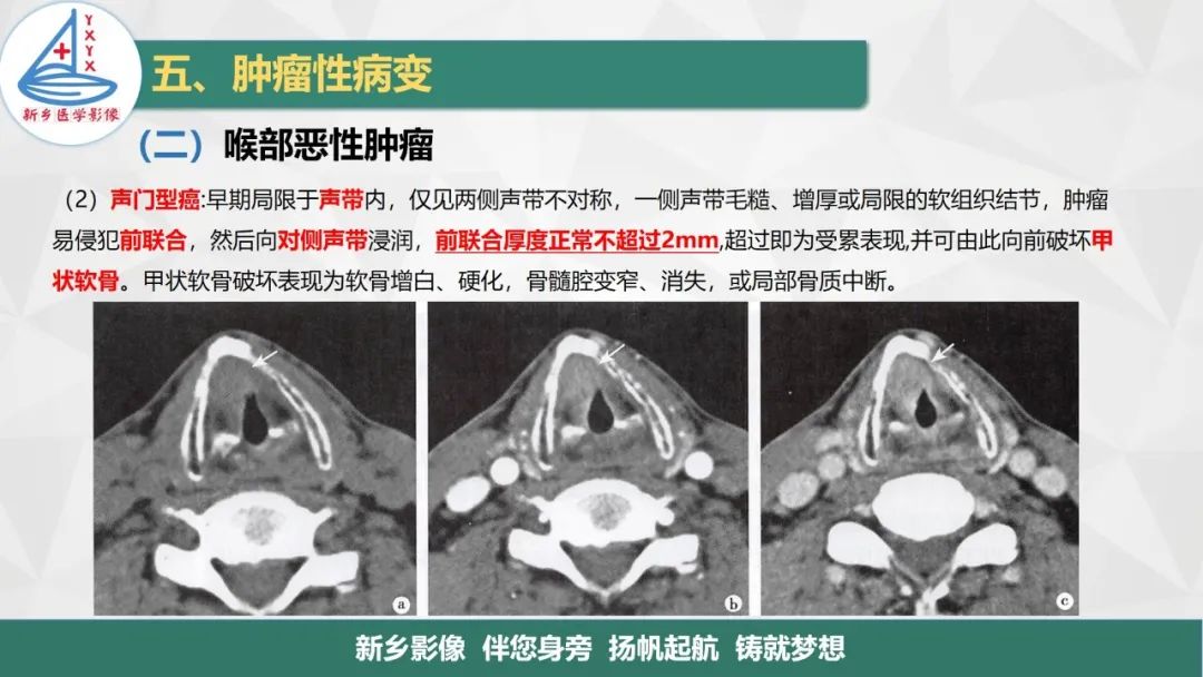 影像PPT - 【PPT】医学影像诊断学教材解读—喉部疾病-27