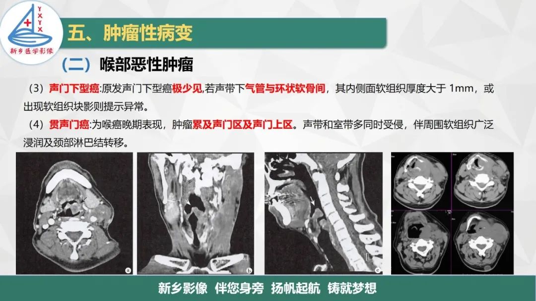 影像PPT - 【PPT】医学影像诊断学教材解读—喉部疾病-28