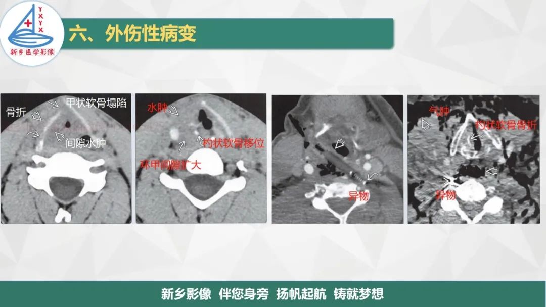 影像PPT - 【PPT】医学影像诊断学教材解读—喉部疾病-30