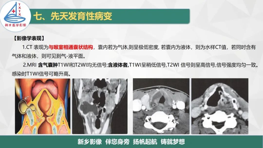 影像PPT - 【PPT】医学影像诊断学教材解读—喉部疾病-32