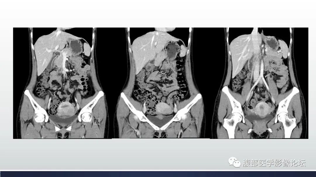 影像PPT - 【病例】膀胱子宫内膜异位症伴腺性膀胱炎1例CT影像-5