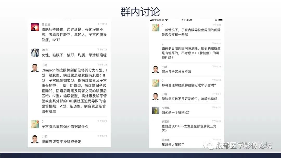 影像PPT - 【病例】膀胱子宫内膜异位症伴腺性膀胱炎1例CT影像-8