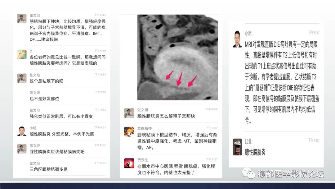 影像PPT - 【病例】膀胱子宫内膜异位症伴腺性膀胱炎1例CT影像-9