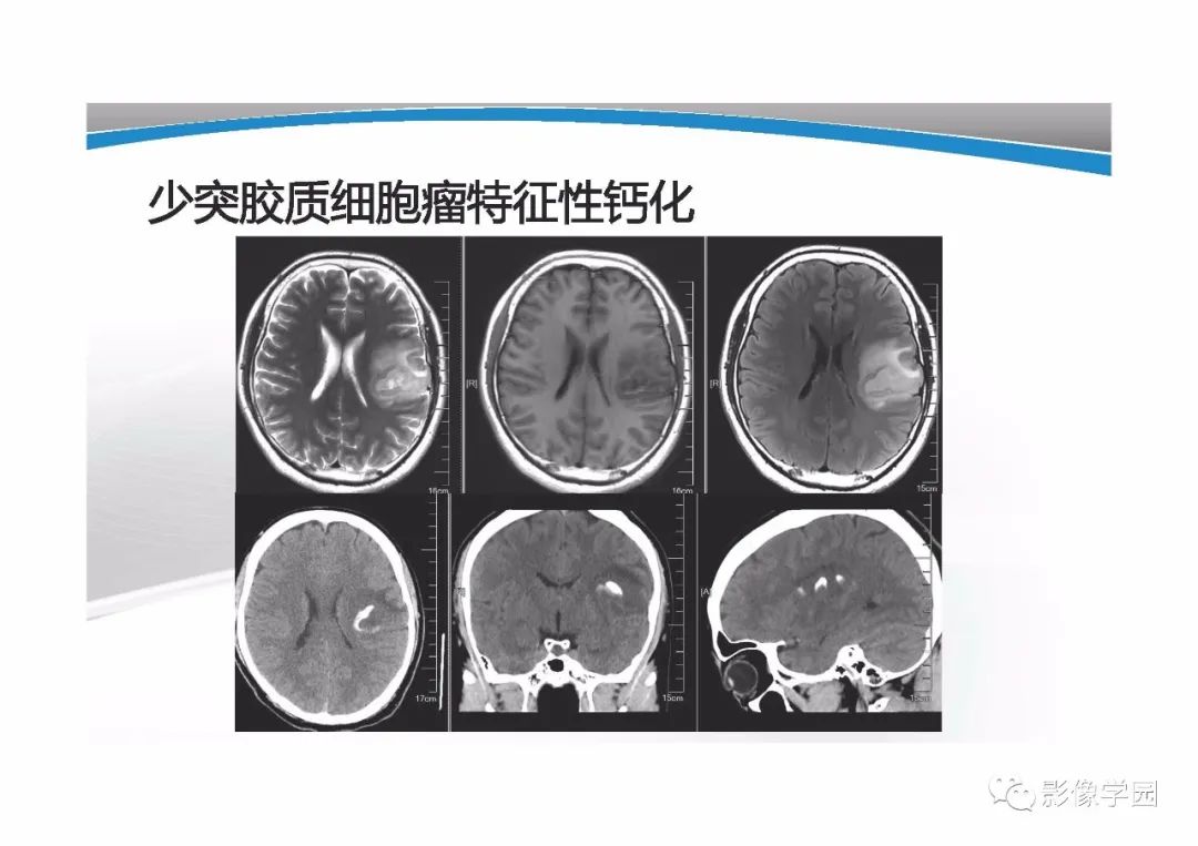 影像PPT - 【PPT】T1WI信号分析与颅内病变图像判读-11