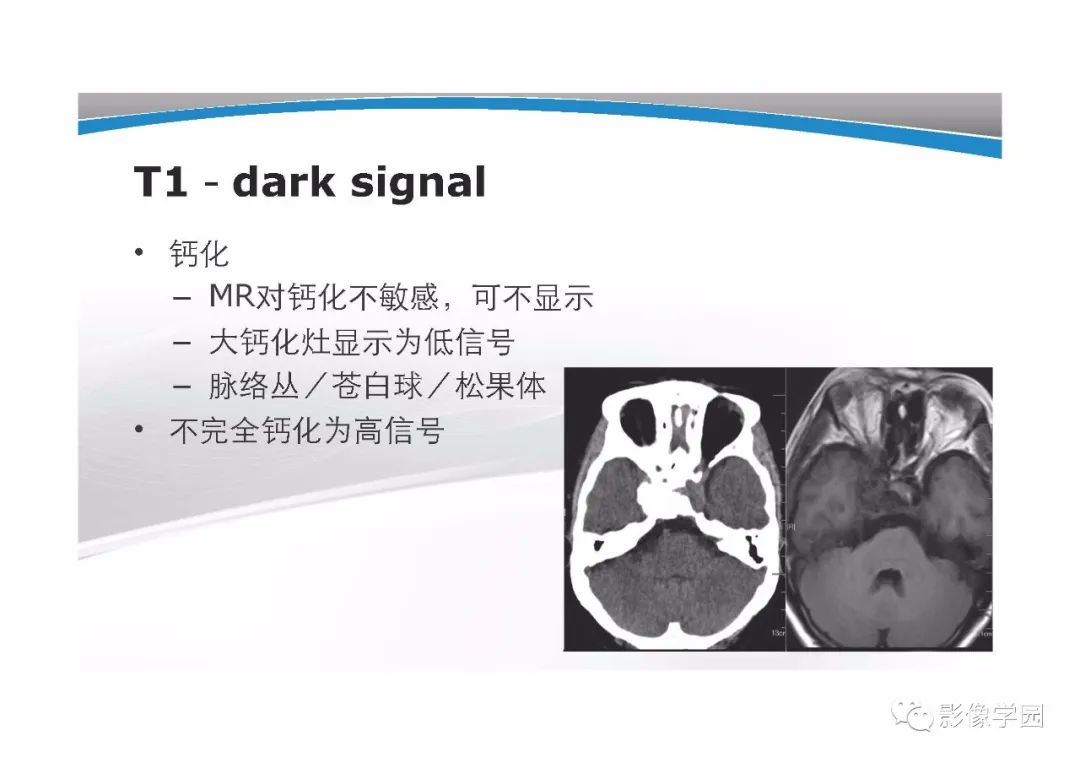 影像PPT - 【PPT】T1WI信号分析与颅内病变图像判读-10