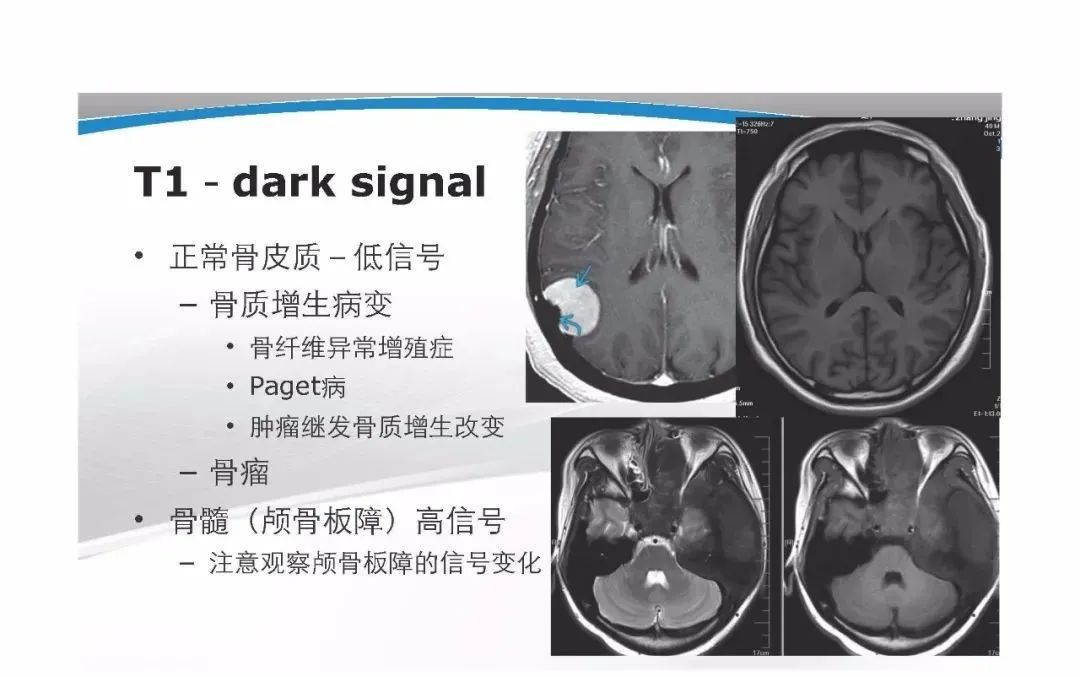 影像PPT - 【PPT】T1WI信号分析与颅内病变图像判读-9