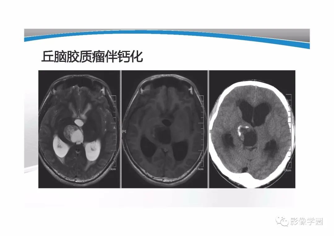 影像PPT - 【PPT】T1WI信号分析与颅内病变图像判读-13