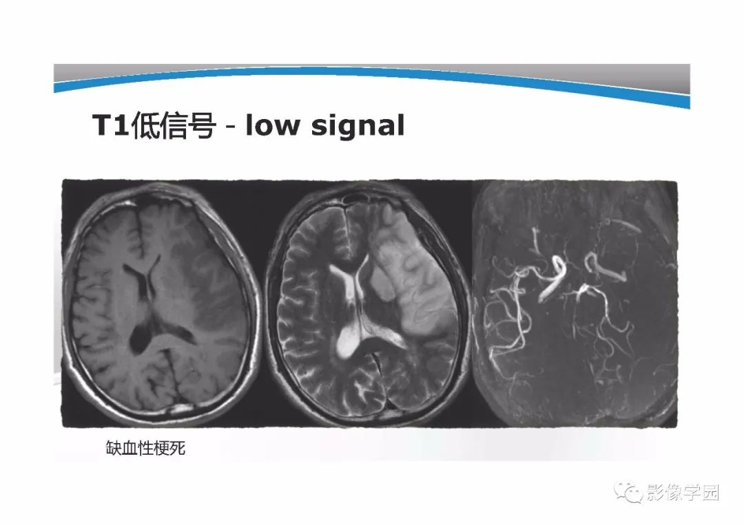 影像PPT - 【PPT】T1WI信号分析与颅内病变图像判读-16