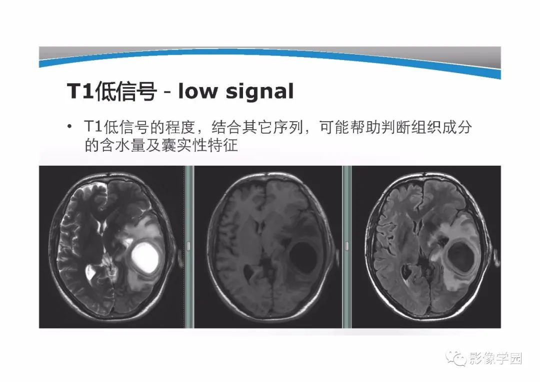 影像PPT - 【PPT】T1WI信号分析与颅内病变图像判读-17