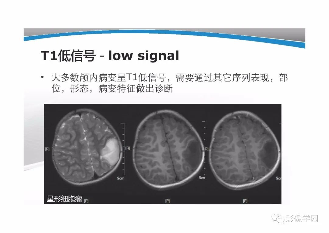 影像PPT - 【PPT】T1WI信号分析与颅内病变图像判读-15