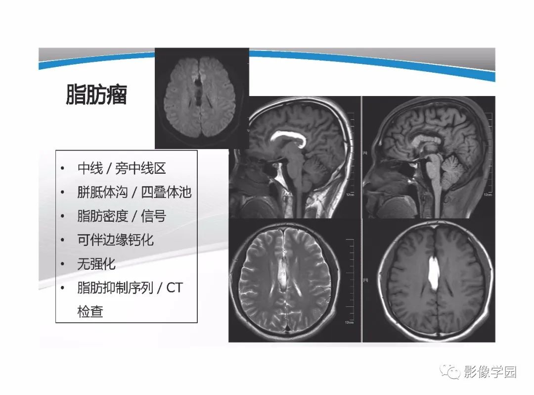 影像PPT - 【PPT】T1WI信号分析与颅内病变图像判读-29