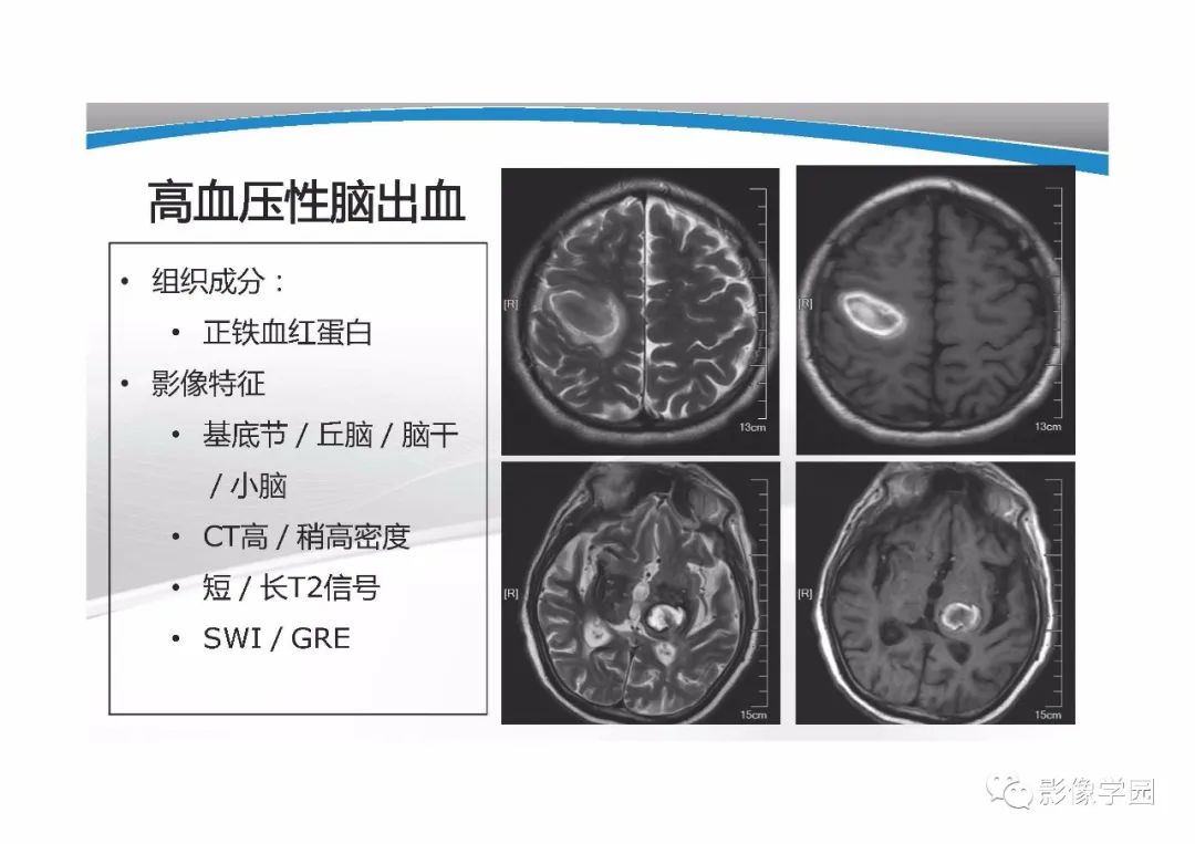 影像PPT - 【PPT】T1WI信号分析与颅内病变图像判读-25