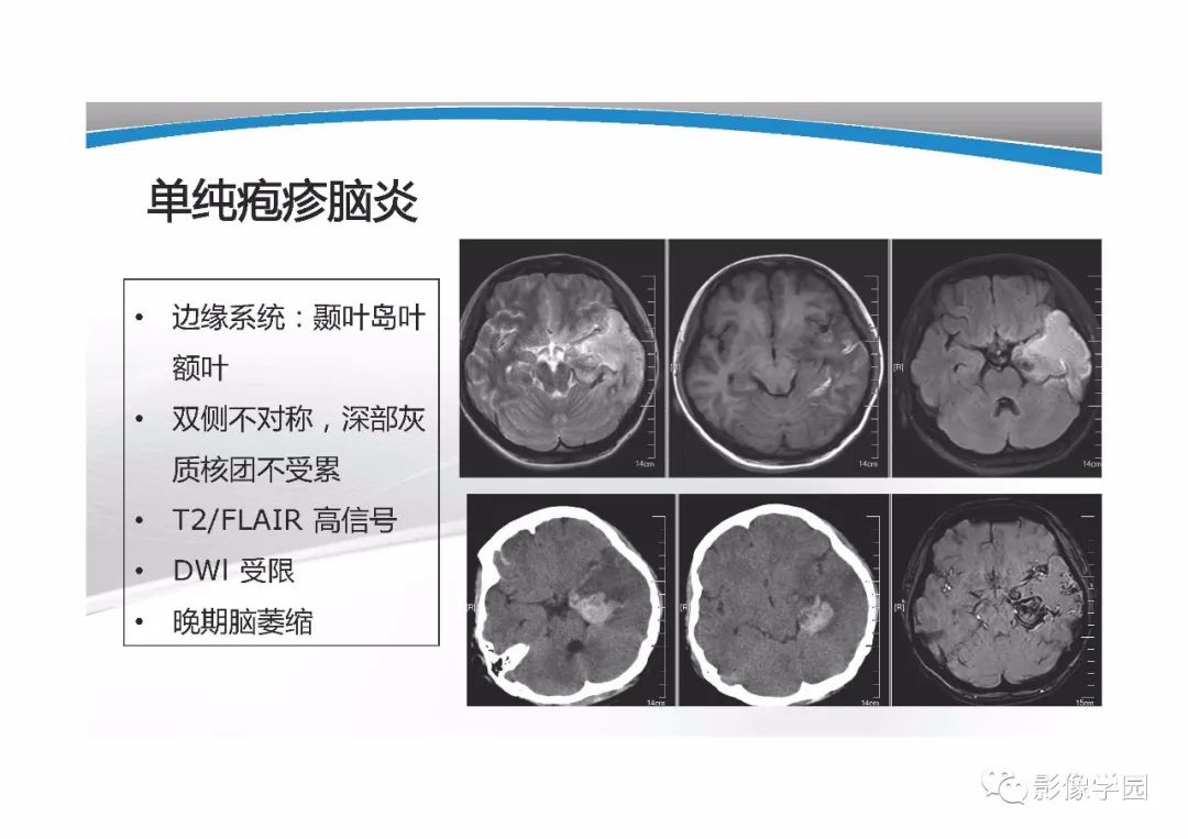影像PPT - 【PPT】T1WI信号分析与颅内病变图像判读-27