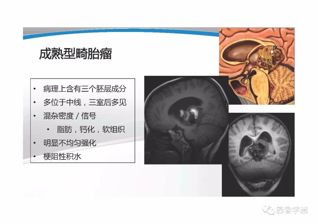 影像PPT - 【PPT】T1WI信号分析与颅内病变图像判读-30