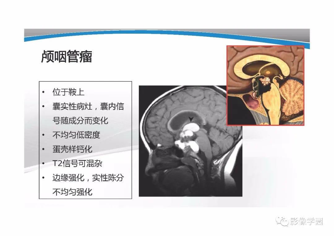 影像PPT - 【PPT】T1WI信号分析与颅内病变图像判读-36