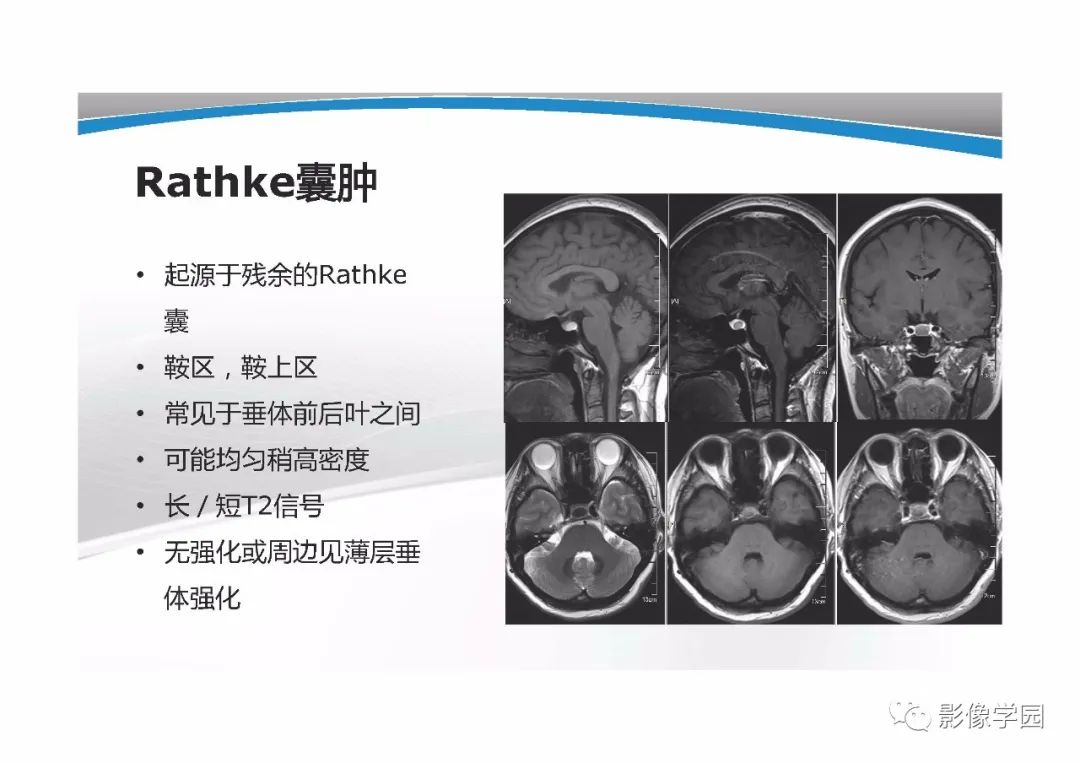 影像PPT - 【PPT】T1WI信号分析与颅内病变图像判读-39