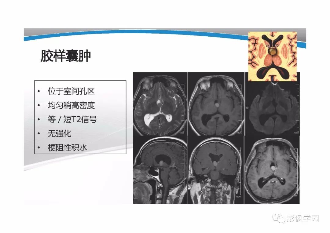 影像PPT - 【PPT】T1WI信号分析与颅内病变图像判读-38