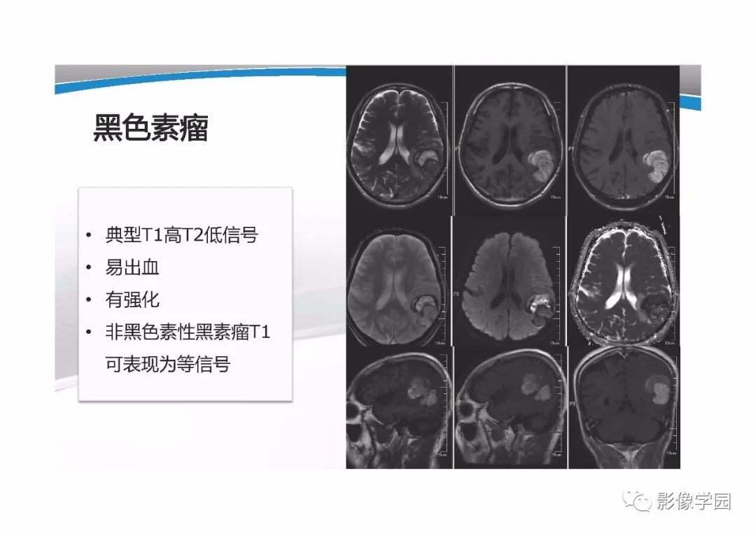 影像PPT - 【PPT】T1WI信号分析与颅内病变图像判读-43