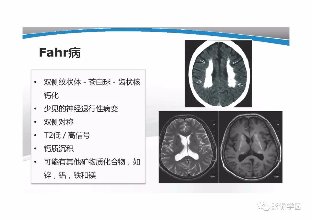影像PPT - 【PPT】T1WI信号分析与颅内病变图像判读-45