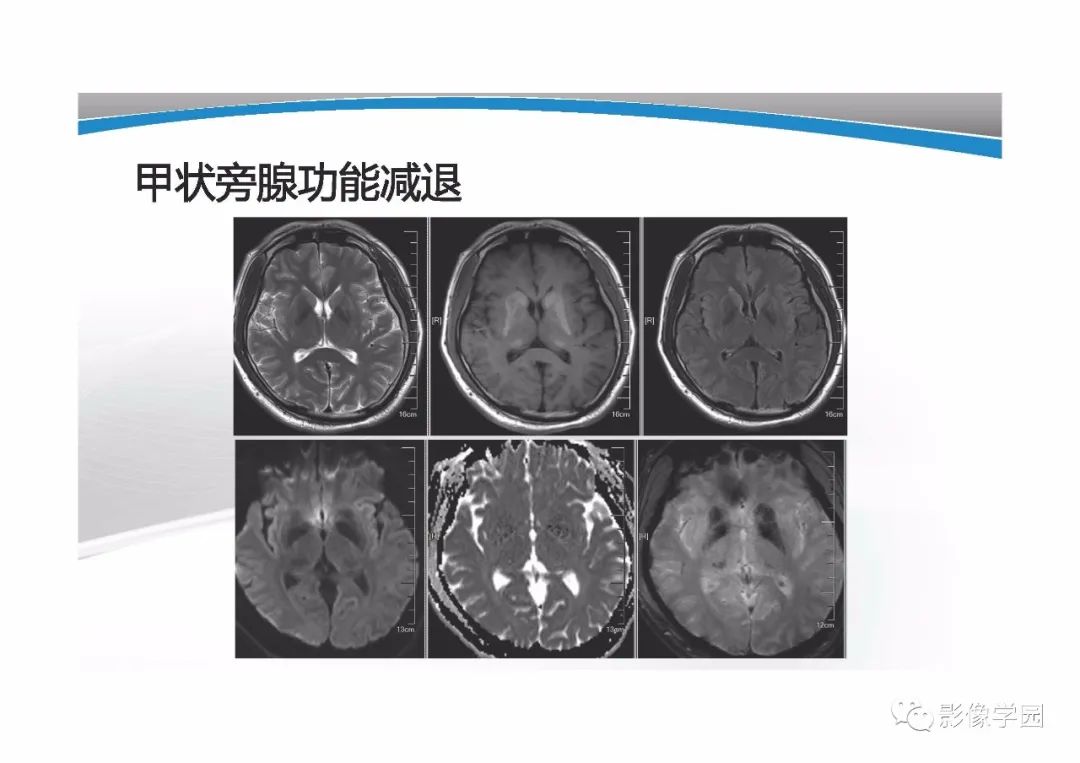 影像PPT - 【PPT】T1WI信号分析与颅内病变图像判读-46