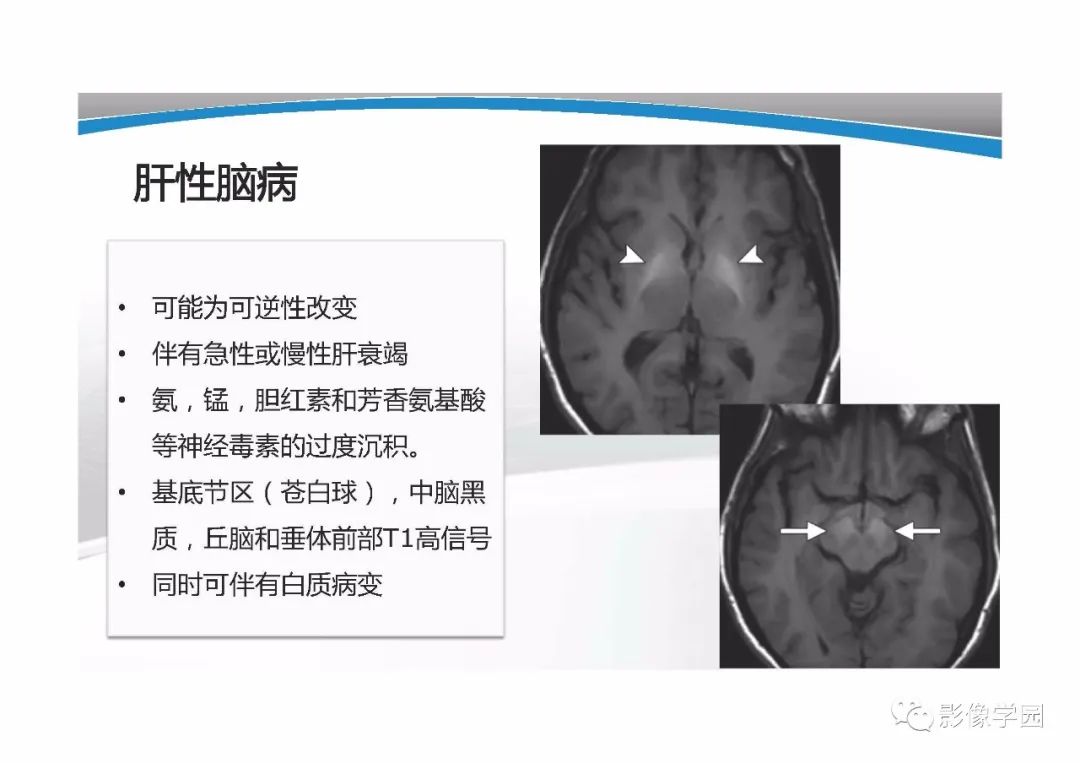 影像PPT - 【PPT】T1WI信号分析与颅内病变图像判读-47