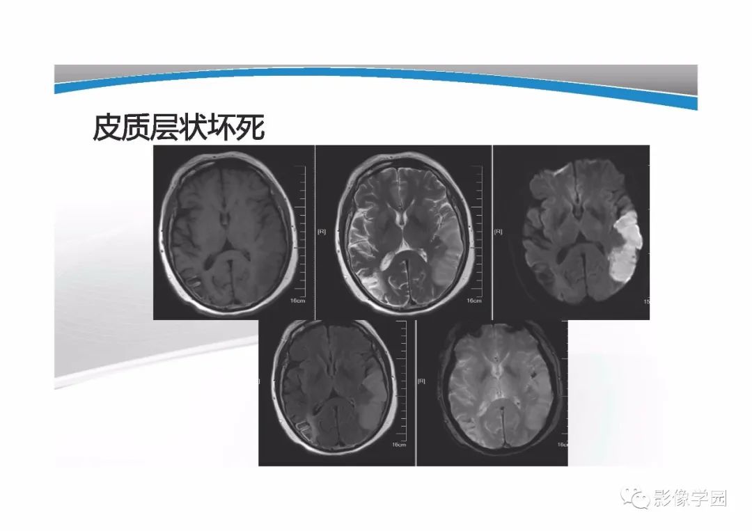 影像PPT - 【PPT】T1WI信号分析与颅内病变图像判读-49