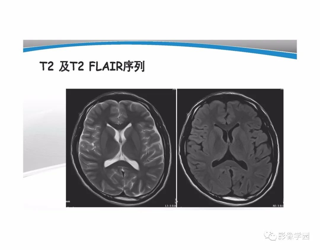 影像PPT - 【PPT】T1WI信号分析与颅内病变图像判读-58