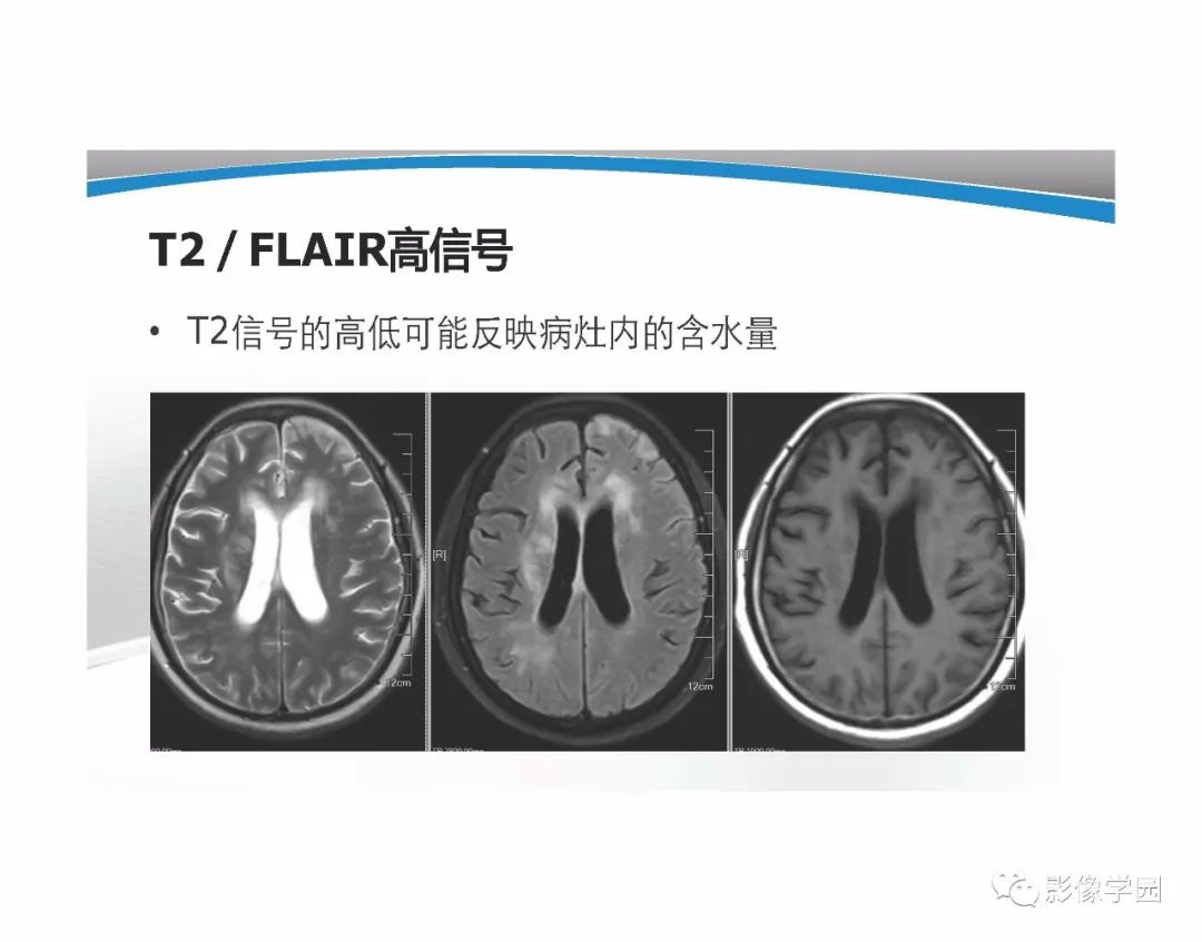 影像PPT - 【PPT】T1WI信号分析与颅内病变图像判读-63