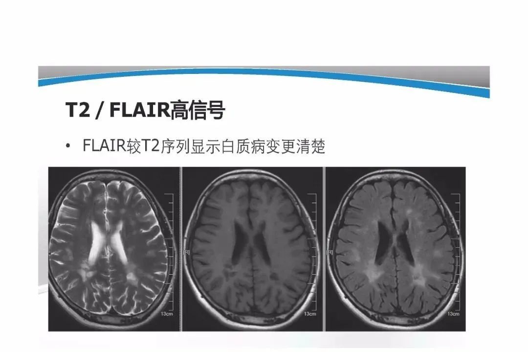 影像PPT - 【PPT】T1WI信号分析与颅内病变图像判读-64