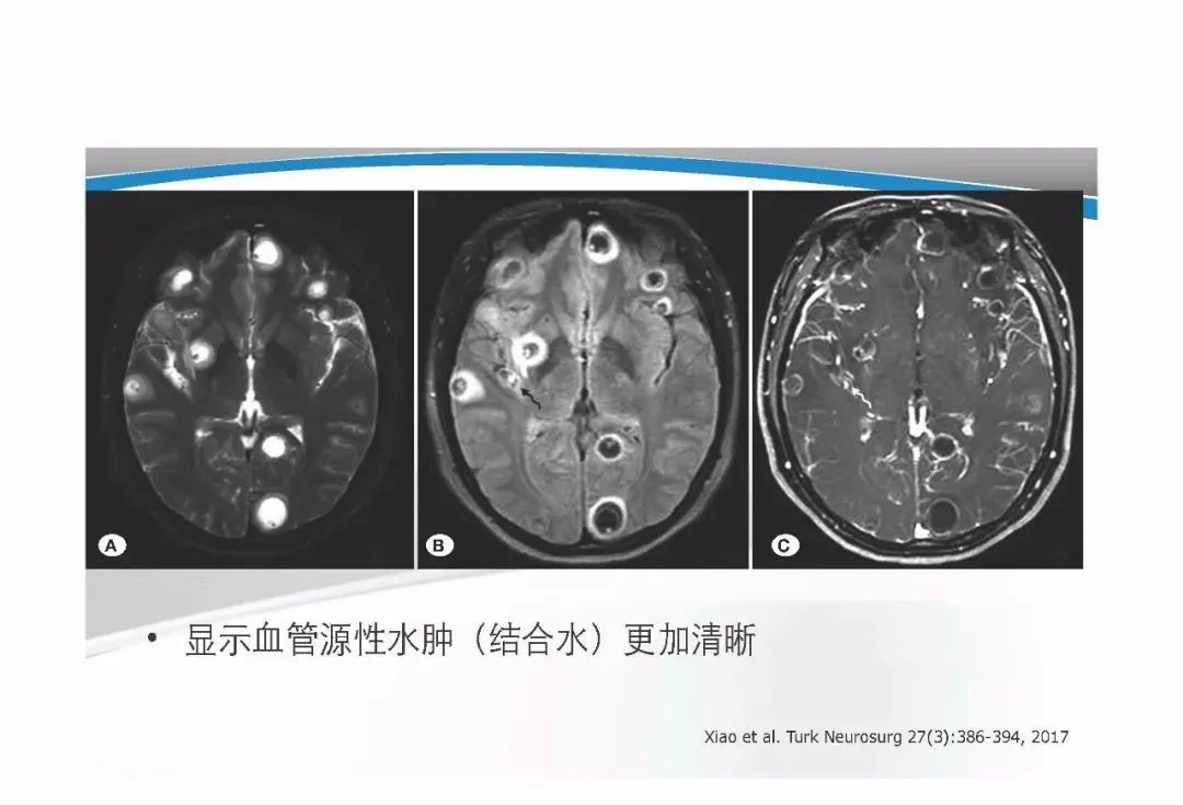 影像PPT - 【PPT】T1WI信号分析与颅内病变图像判读-66