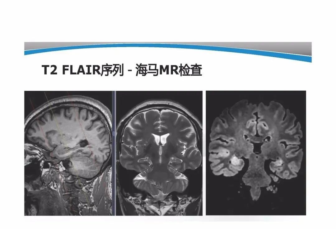 影像PPT - 【PPT】T1WI信号分析与颅内病变图像判读-67