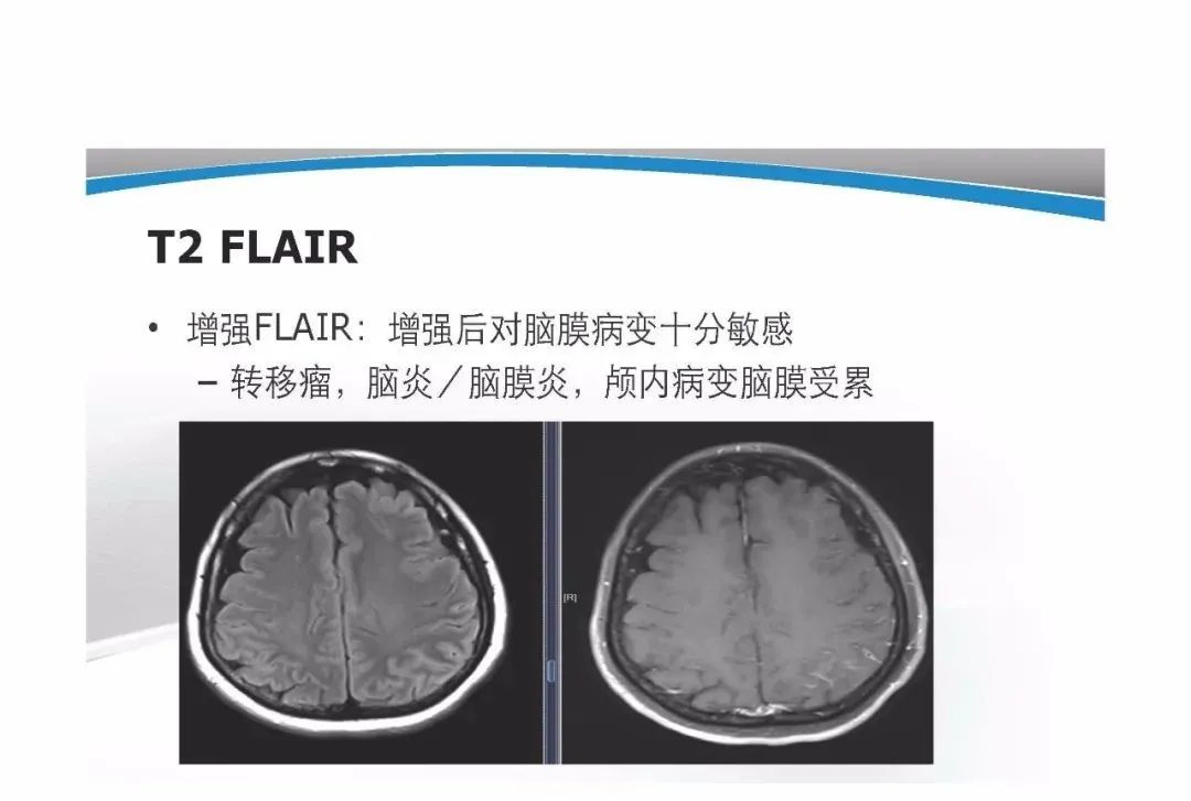 影像PPT - 【PPT】T1WI信号分析与颅内病变图像判读-69