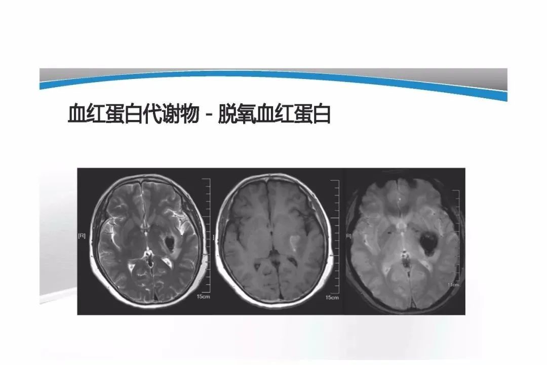 影像PPT - 【PPT】T1WI信号分析与颅内病变图像判读-78