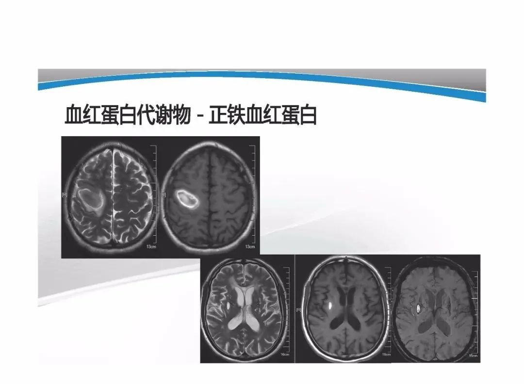 影像PPT - 【PPT】T1WI信号分析与颅内病变图像判读-79