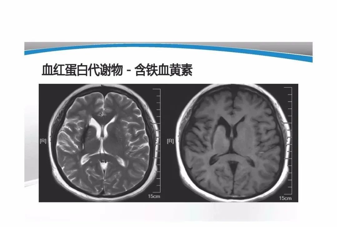 影像PPT - 【PPT】T1WI信号分析与颅内病变图像判读-80