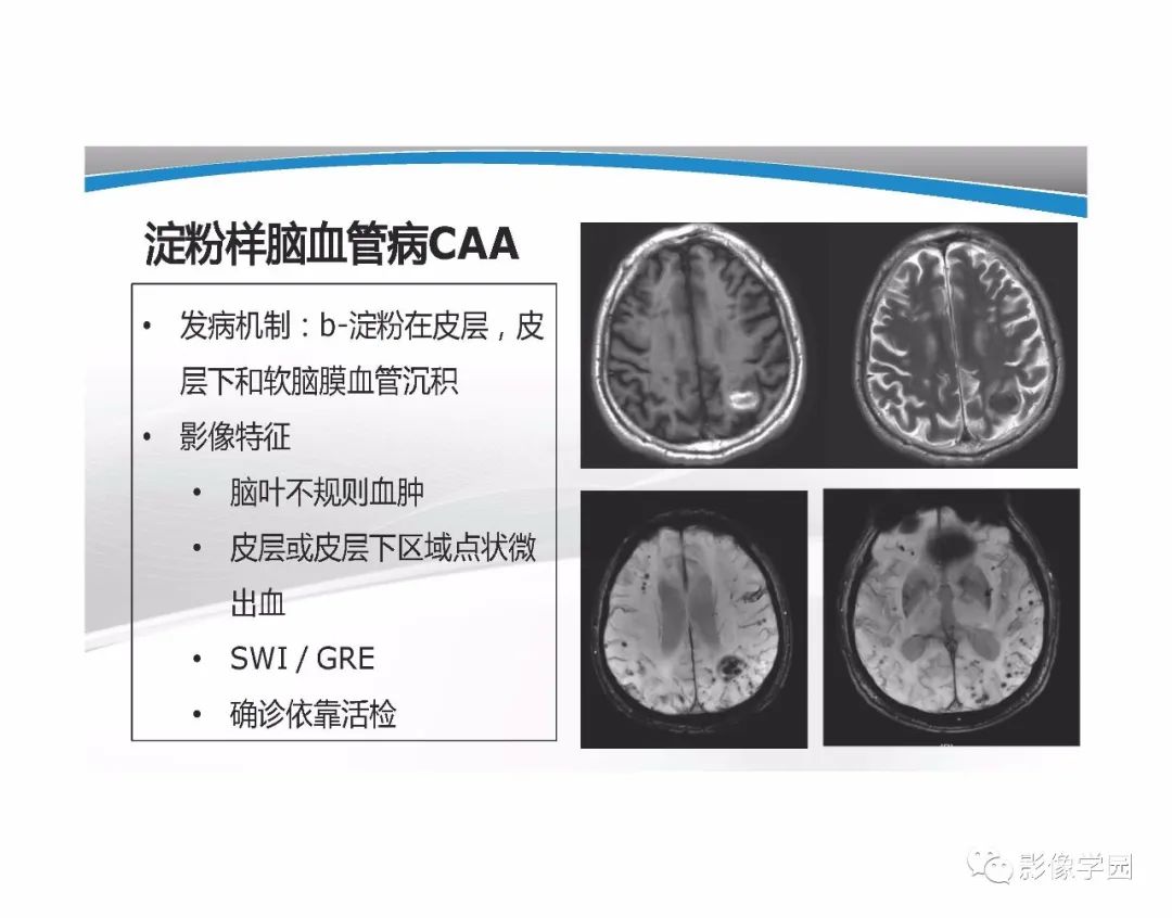 影像PPT - 【PPT】T1WI信号分析与颅内病变图像判读-82
