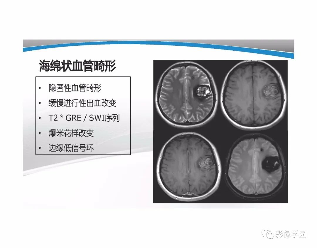 影像PPT - 【PPT】T1WI信号分析与颅内病变图像判读-84