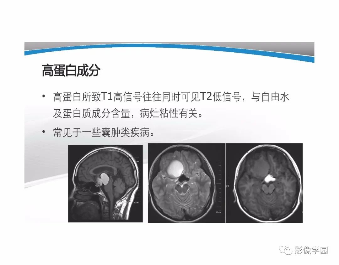 影像PPT - 【PPT】T1WI信号分析与颅内病变图像判读-85