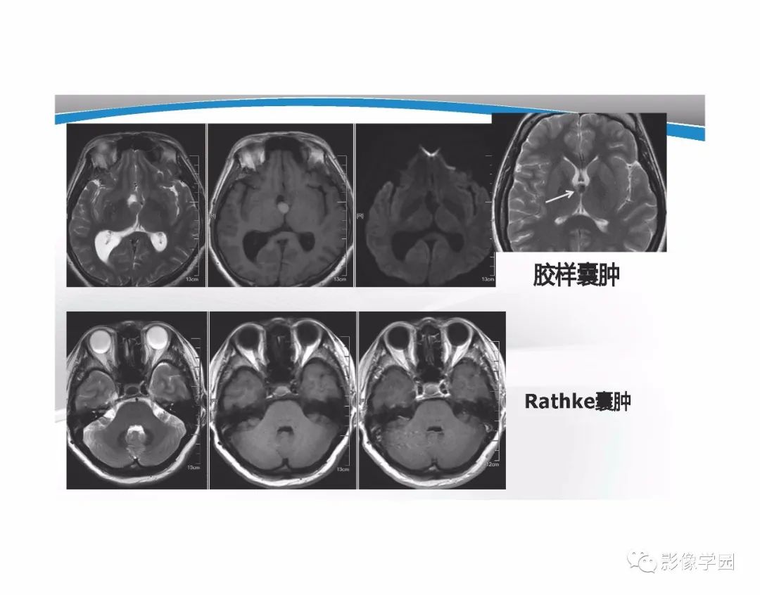 影像PPT - 【PPT】T1WI信号分析与颅内病变图像判读-86