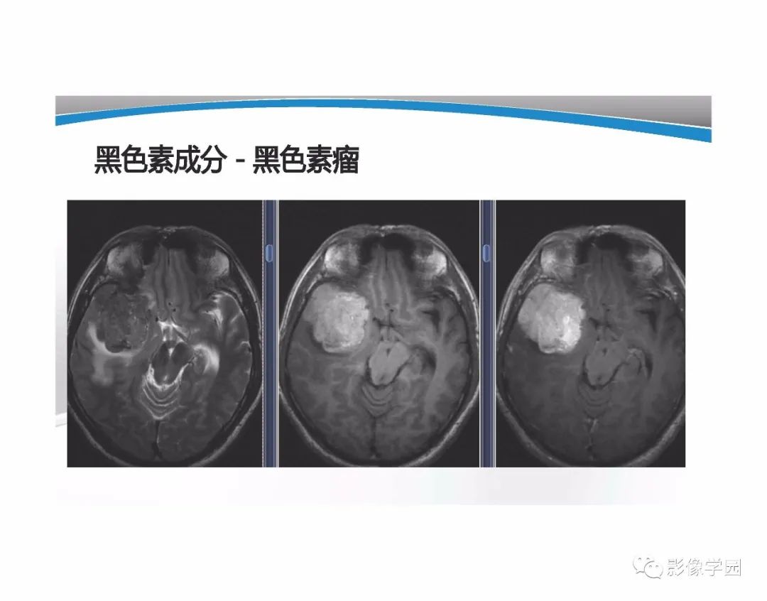 影像PPT - 【PPT】T1WI信号分析与颅内病变图像判读-87