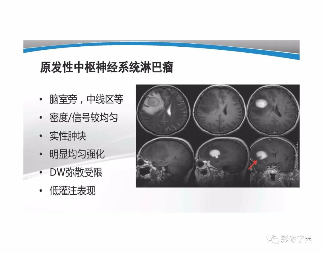 影像PPT - 【PPT】T1WI信号分析与颅内病变图像判读-90