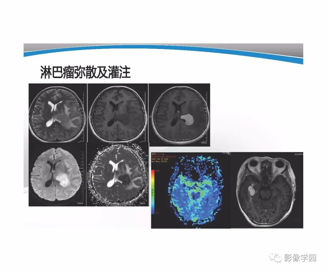 影像PPT - 【PPT】T1WI信号分析与颅内病变图像判读-91