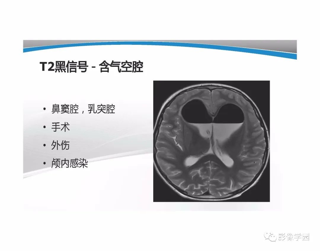 影像PPT - 【PPT】T1WI信号分析与颅内病变图像判读-96