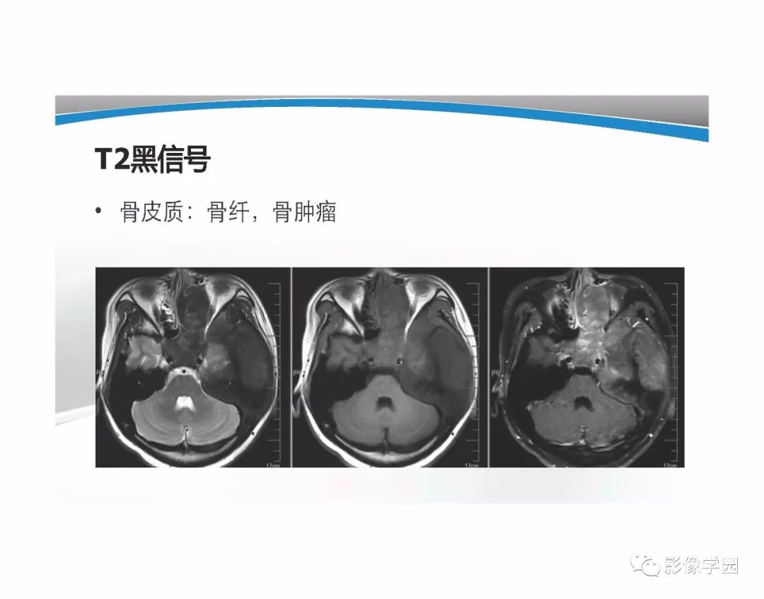 影像PPT - 【PPT】T1WI信号分析与颅内病变图像判读-94