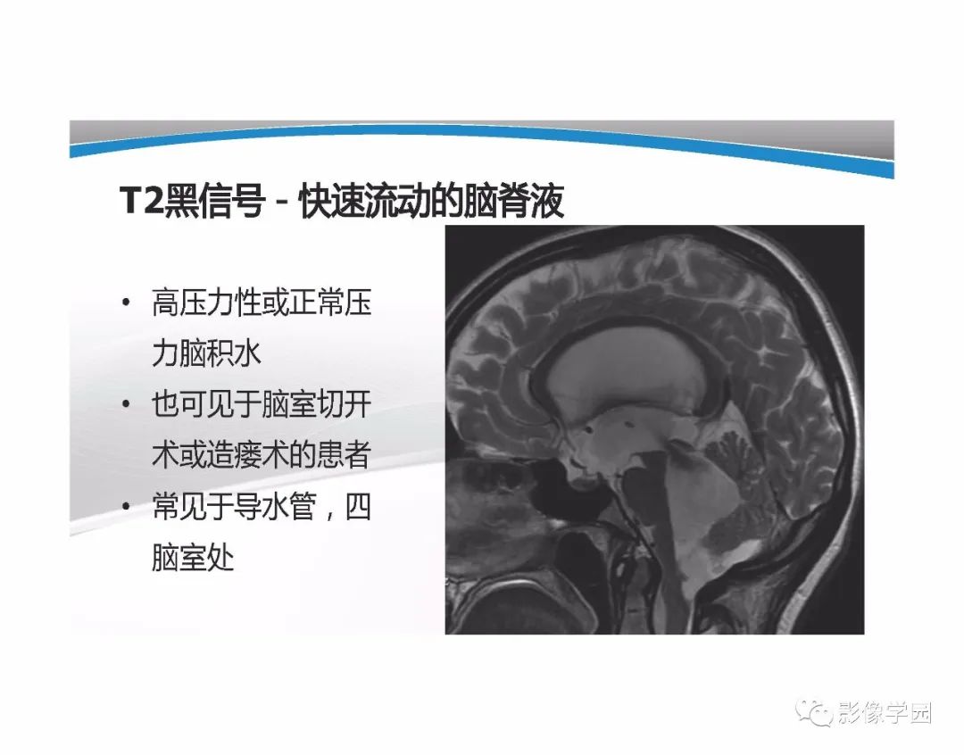 影像PPT - 【PPT】T1WI信号分析与颅内病变图像判读-95