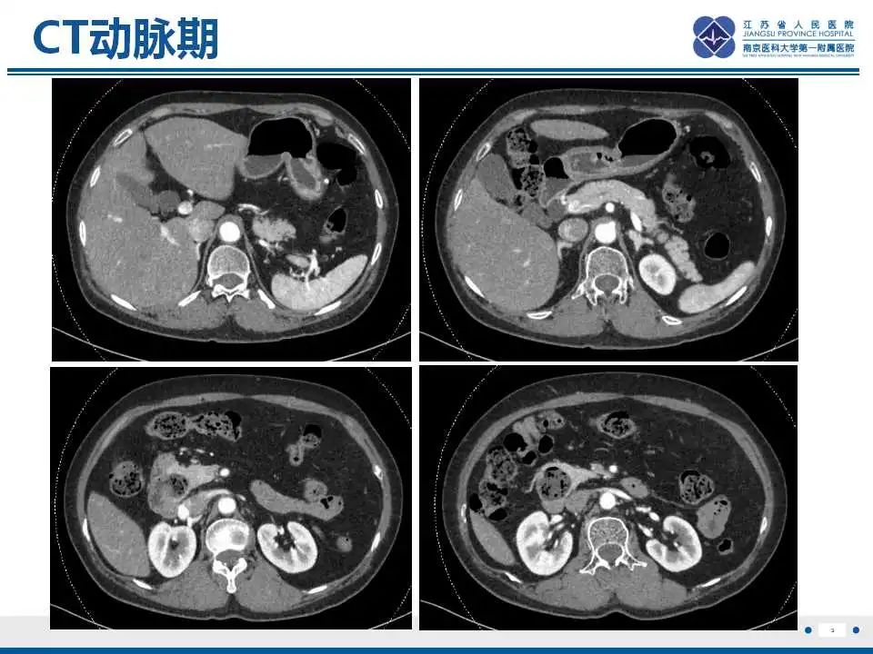 影像PPT - 【PPT】十二指肠乳头旁憩室综合征-4