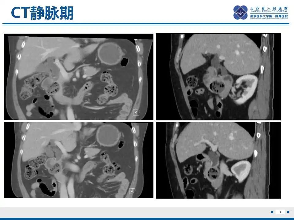 影像PPT - 【PPT】十二指肠乳头旁憩室综合征-6
